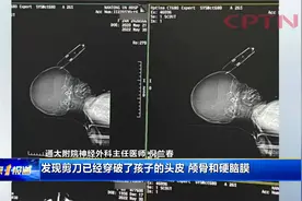 江苏：惊险万分！剪刀插入2岁女童额头 离眼睛仅一厘米多视频封面