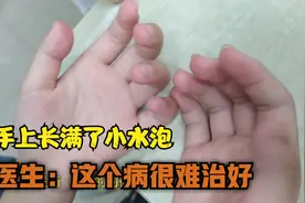 手上脚上长满小水泡，一到夏天就复发，医生：这个病很难治好视频封面