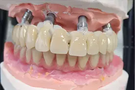 人类第三副牙齿之种植基台研磨休整