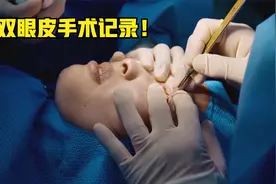 世界整形手术之都：双眼皮手术全程记录！烧伤女孩进手术室围观视频封面