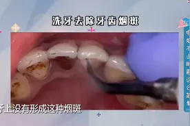 吸烟的人牙齿又黄又黑有烟斑，如何去除？视频封面