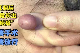 姑娘打耳洞后长出一大颗“肉疙瘩” 又要手术又要放疗视频封面