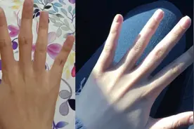 改善手指关节粗大，拥有一双纤纤玉手，和肉肉手说拜拜！视频封面