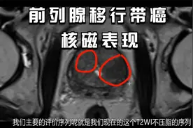 回答网友问题（二）：移行带前列腺癌核磁表现视频封面