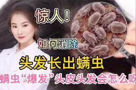 头上的螨虫“爆发”人体头皮和头发会怎样 日常如何预防和消除视频封面
