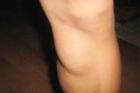 腿上长了一个包，硬硬的不疼不痒，多半是这3个情况视频封面