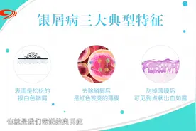 银屑病易混淆，在家我们该如何自查呢？专家给出银屑病三大特征视频封面