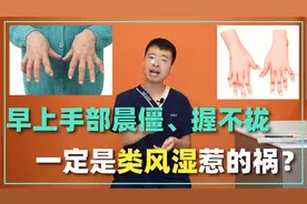 早晨起来手发胀，握不拢，活动活动就缓解！一定是类风湿惹的祸？视频封面