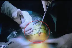 太可怕！中山一女子被10cm断筷卡住喉咙，命悬一线视频封面