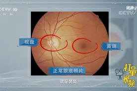 出现视力下降、模糊，一定要及时就医，可能是黄斑变性|健康之路视频封面