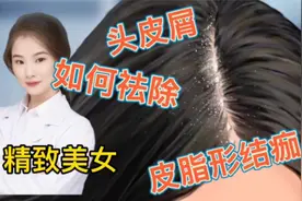 医学演绎 精致美女头皮长满大量头皮削 皮脂性结痂怎么办 祛除