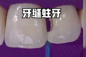 两颗牙中间的牙缝蛀了怎么补呢？视频封面
