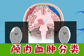 医学动画|硬膜外出血 VS. 硬膜下出血 VS. 脑内出血视频封面