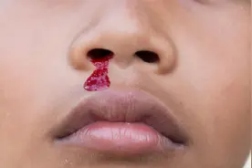 孩子老流鼻血怎么回事？一个简单的动作即可止血视频封面