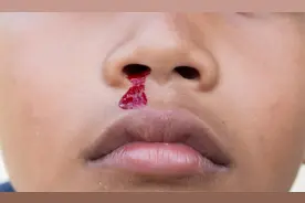 孩子老流鼻血怎么回事？一个简单的动作即可止血视频封面