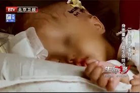 1岁男婴脑袋重达15斤，头上血管清晰可见，颅内惊现“定时炸弹”视频封面
