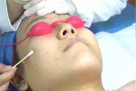 激光点阵剥脱去痘坑痘印vlog，医美恢复期记录视频封面
