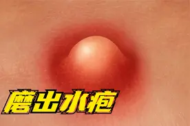 脚上磨起了泡怎么办？要不要挑破?视频封面