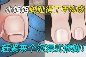 小姐姐常年穿高跟鞋，趾甲得了甲沟炎和鸡眼！赶紧请出顶级修脚师视频封面