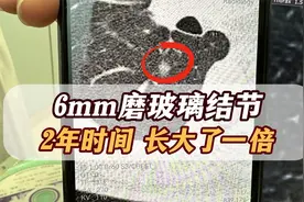 6mm磨玻璃结节，2年长大了一倍！已经变成实性结节了视频封面