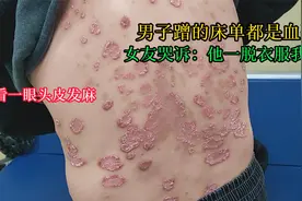 男子蹭的床单都是血跟皮，女友哭诉：他一脱衣服我心慌：牛皮癣视频封面