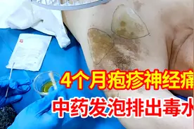 治疗实录：比较严重的带状疱疹神经痛，中药古法【发泡排出毒水】视频封面