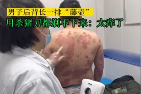 男子后背长一排“藤壶”，杀猪刀都剃不下来，千里求助大夫牛皮癣视频封面