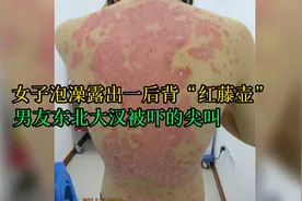 女子泡澡露出一后背红“藤壶”，男友一个东北大汉被牛皮癣吓尖叫视频封面