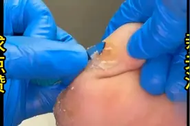 解压视频（刮脚）视频封面