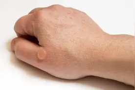 烫伤起水泡，挑破还是不挑破好？烧伤科医生告诉你正确处理方式视频封面