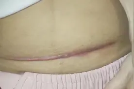 两年剖腹产疤痕都没了！这方法你真得看！视频封面