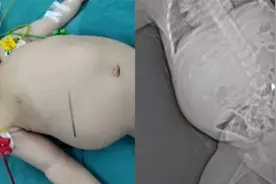 陕西一7个月大婴儿体内长15公分大肿瘤 腹部肿胀大如皮球视频封面