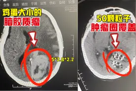 72岁脑胶质瘤，从广州到长沙慕名求医，50颗粒子植入、精准灭瘤！视频封面