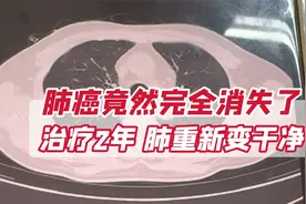 肺癌竟然完全消失了！治疗了2年，肺重新变干净了视频封面