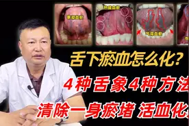 舌下瘀血怎么化？4种舌象4种方法，清除一身瘀堵，活血化瘀！视频封面
