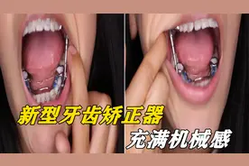 不可思议的牙齿矫正器，两侧有滑轮和连接杆，现实版的“机械嘴”视频封面