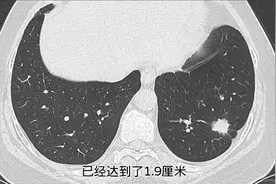 实性肺结节，见到3个恶性表现，要果断视频封面