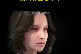 3D动画演示鹰钩鼻整容手术视频封面