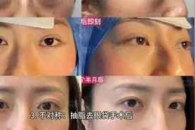 抽脂去眼袋有风险吗？视频封面