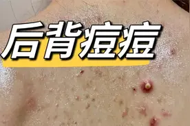 螨虫滋生后背长痘痘？过来人除螨方法大公开！顽固痘印一洗就掉！视频封面
