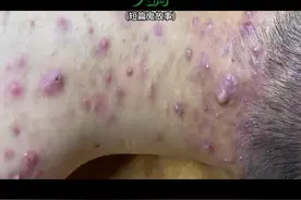 短篇鬼故事（99）#解压挤痘痘 #短篇故事#恐怖故事视频封面