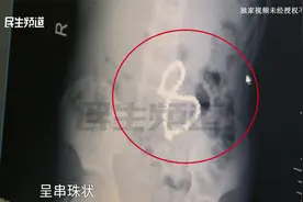 危险！五岁男童腹痛难忍查出肠穿孔 ，手术竟取出35颗磁力珠视频封面