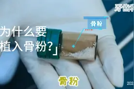 种植牙一定要植入骨粉吗？？？？视频封面