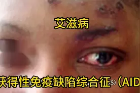 艾滋病，即获得性免疫缺陷综合征（AIDS）视频封面