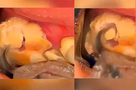 超解压洗牙视频，看之前没想到牙结石能长这么大视频封面