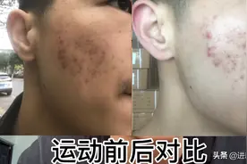 运动过后感觉痘痘有点改变，加油💪🏿视频封面