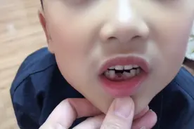 乳牙没掉新牙已经长出来了，这种情况拔牙后新牙还能长正吗？视频封面