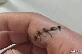 不打麻药缝针，真疼。图片