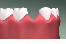 缺牙不种，后果严重❓视频封面