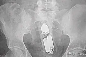 好多人喜欢没事在自己体内放一些东西玩或者出现意外残留在体内 图片